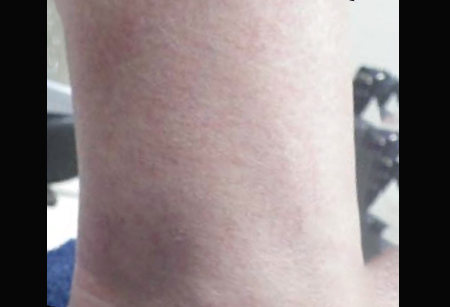 Vascular Lesions - Stellar IPL + Multi-Spot ND-2-A