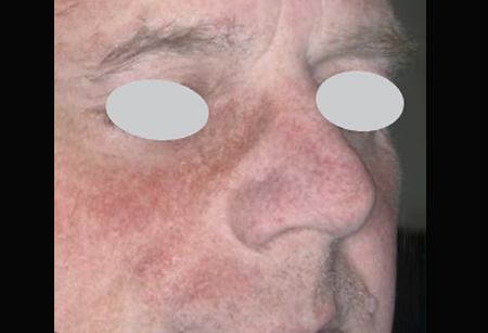 Vascular Lesions - Stellar IPL + Multi-Spot ND-3-A