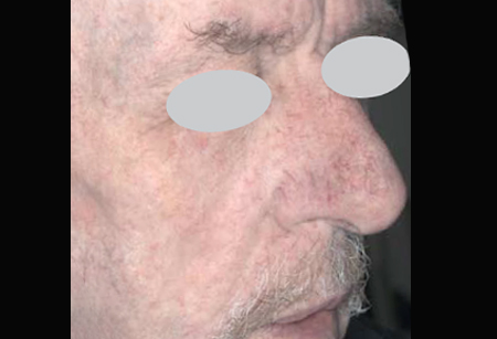 Vascular Lesions - Stellar IPL + Multi-Spot ND-4-A