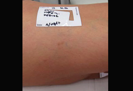 Leg-Veins-Multi-Spot-Nd-1-A
