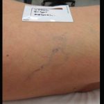 Leg-Veins-Multi-Spot-Nd-1-B