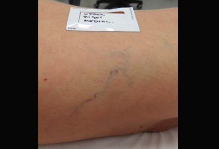 Leg-Veins-Multi-Spot-Nd-1-B