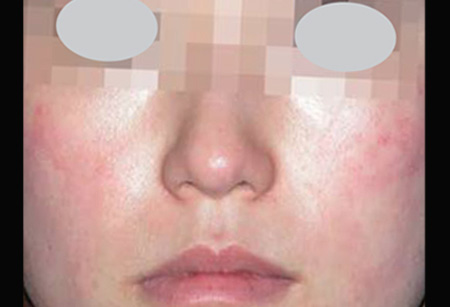 Skin-Rejuvenation-Stellar-IPL-20-A