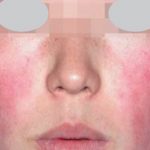 Skin-Rejuvenation-Stellar-IPL-20-B