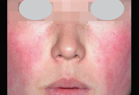 Skin-Rejuvenation-Stellar-IPL-20-B